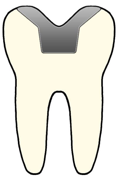 Dental Onlays, Cosmetic Dentistry