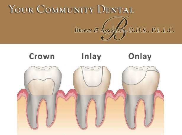 Carolinas Dental Choice, Dental Crowns, Dental Fillings, Dental Work