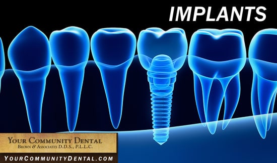 Soins dentaires, Appareil dentaire, Écart entre les dents, Your Community Dental, Implants, Facettes, Couronnes, Collage