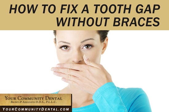 How To Fix A Tooth Gap Without Braces - Your Community Dental