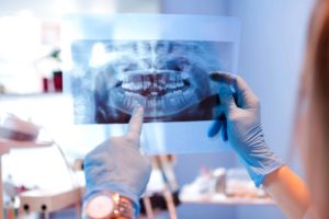 Dental Xray Dental Xray Wilmington NC