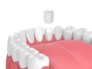 3d render of teeth with veneer